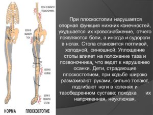 Нарушения в организме при плоскостопии