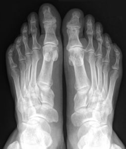 Рентгенография костей и суставов