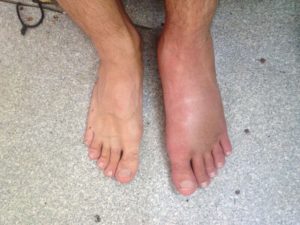 Отёк ноги после перелома