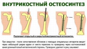 Остеосинтез ноги