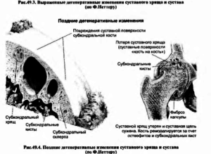 Поздние дегенеративные изменения