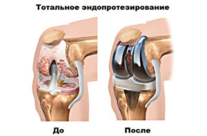 Эндопротезировани коленного сустава