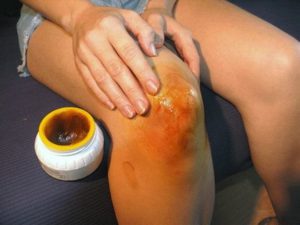 Домашнее средство для лечения артроза коленного сустава