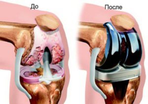 Эндопротезирование коленного сустава
