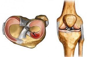 Разрыв коленного мениска