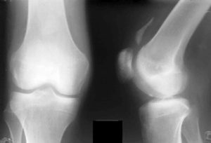 Опухоль при гемартрозе колена