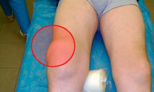 Воспаление коленного сустава