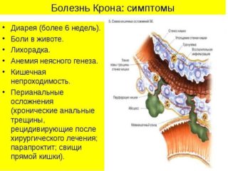 Симптомы болезни Крона