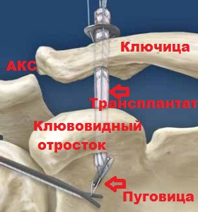 Акс ключицы. Разрыв акромиально-ключичного сустава операция. Операция по разрыву акромиально-ключичного сочленения. Операция на акромиально-ключичного сочленения.