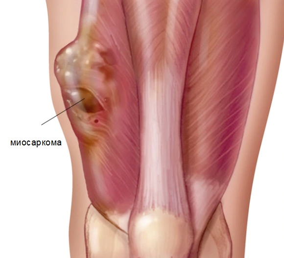 Миосаркома в скелетной мышце