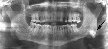 Остеома челюсти на снимке МРТ