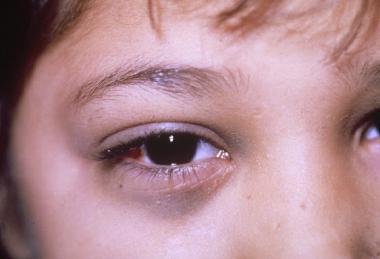Симптом нейробластомы в области глаз