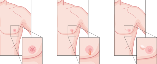 Симптомы повреждения соска грудной железы