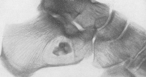 Секвестр пяточной кости на рентгенограмме при остеомиелите пяточного бугра