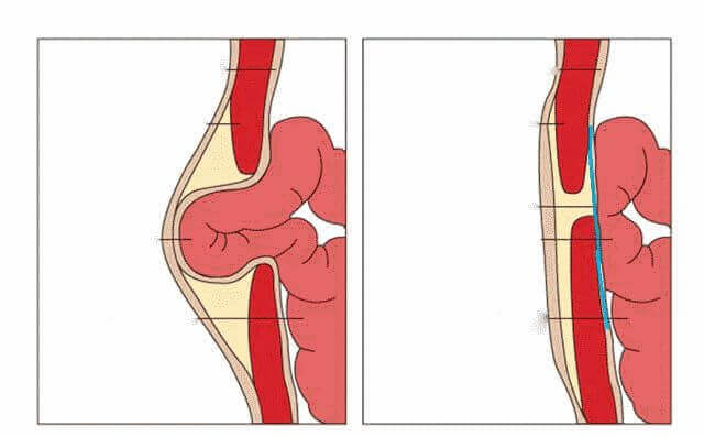 Пупочная грыжа у женщин: симптомы