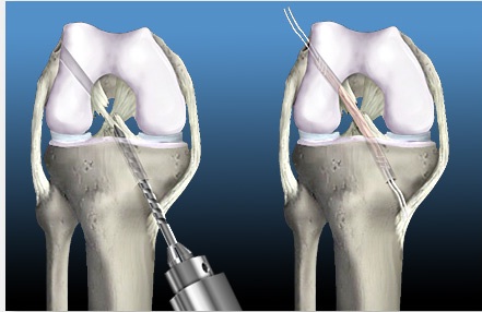 передняя крестообразная связка коленного сустава