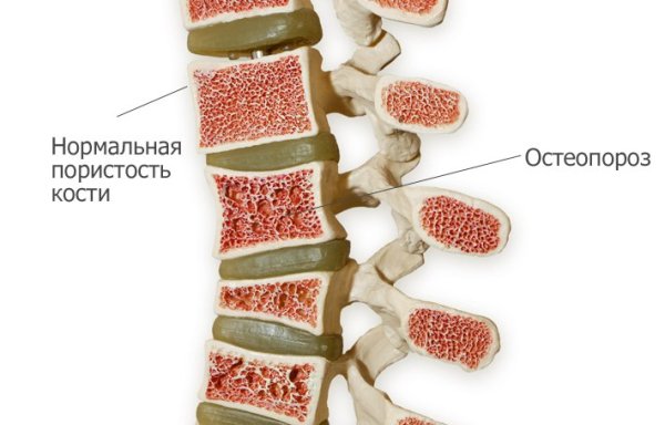 остеопороз поясничного отдела лечение