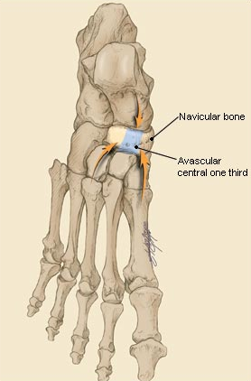 Ладьевидная кость стопы перелом симптомы