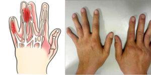 Заболевание в пальцах рук