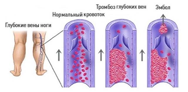 Тромбоз глубоких вен