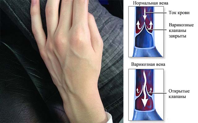 Схематическое изображение варикоза