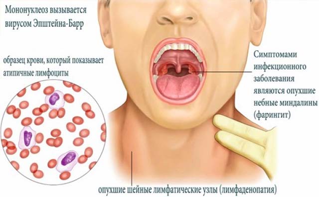 Мононуклеоз