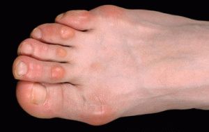 Мозолистые пальцы ног