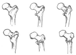 Виды переломов