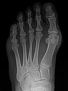 Рентгенография пальцев ног