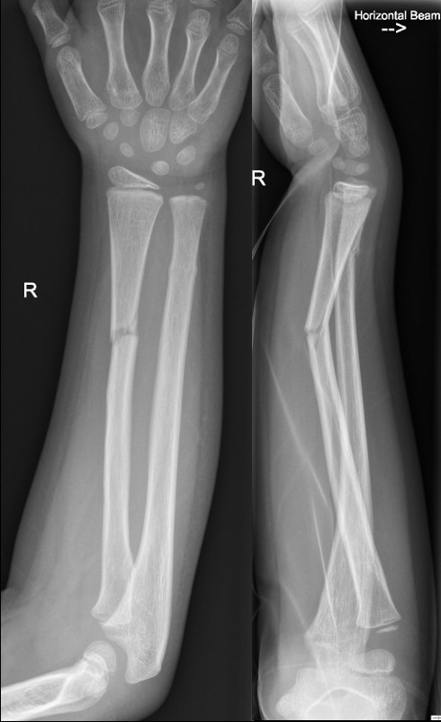 An X-Ray image of a Greenstick fracture of radius shaft with 20 degrees of dorsal angulation and minimally displaced ulna fracture