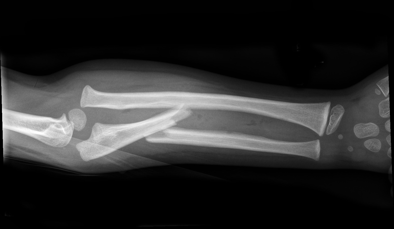 An x-Ray image of a Monteggia fracture dislocation showing ulna shaft fracture with radial head dislocation