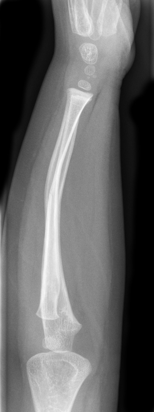 An X-Ray of Plastic deformity of radius and ulna with volar tilt