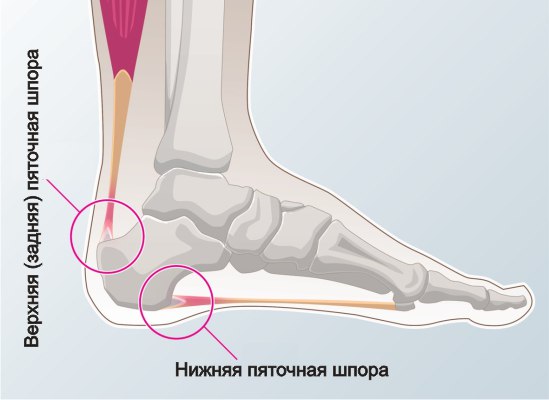 Схема расположения верхней и нижней пяточной шпоры