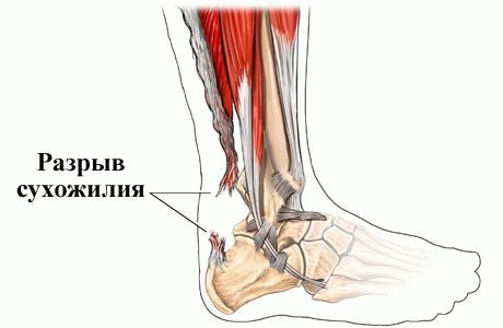 Причины боли и способы лечения ахиллова сухожилия