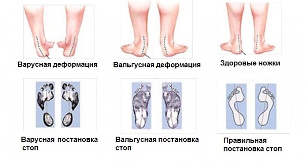 Вальгусная (варусная) деформация ступней и пяток. Причины развития, методы лечения у детей и взрослых