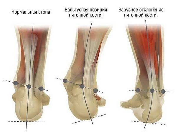 Вальгусная (варусная) деформация ступней и пяток. Причины развития, методы лечения у детей и взрослых