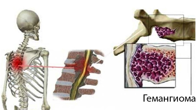 Гемангиома позвоночника
