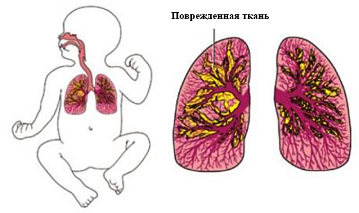 Поврежденная ткань