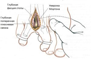 Неврома Мортона