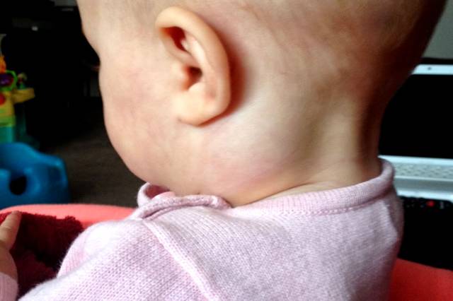 Воспаление лимфоузлов на шее у ребенка