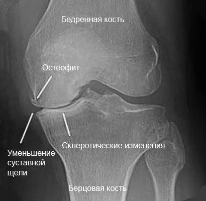 Остеофиты и склероз колена