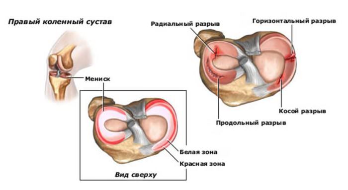 Повреждения мениска коленного сустава