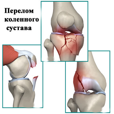 перелом колена