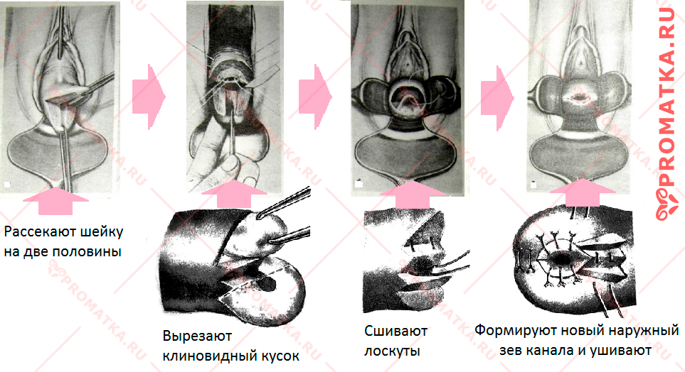 Операция Шредера