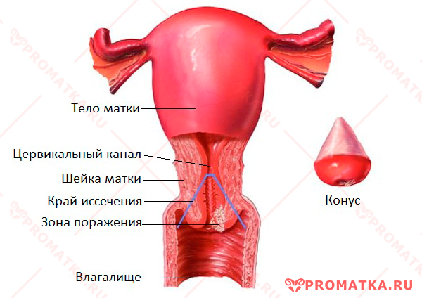Конизация шейки. Коническая шейки матки. Коническая шейка матки. Шейкатматки коническая. Шейка конической формы.