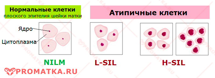 Атипичные клетки – схема