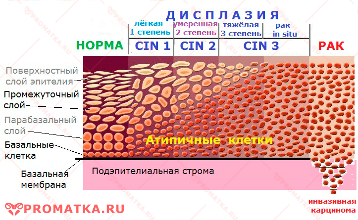 Три степени дисплазии шейки матки
