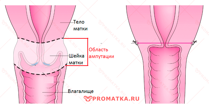 Ампутация шейки матки 