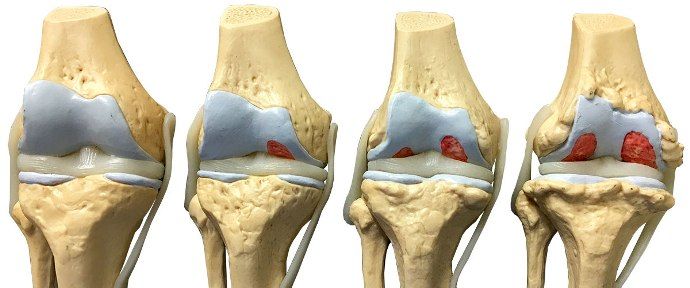 суставы при ревматоидном артрите