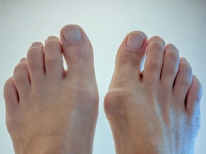 Особенности лечения подагры на большом пальце ноги: симптомы ...